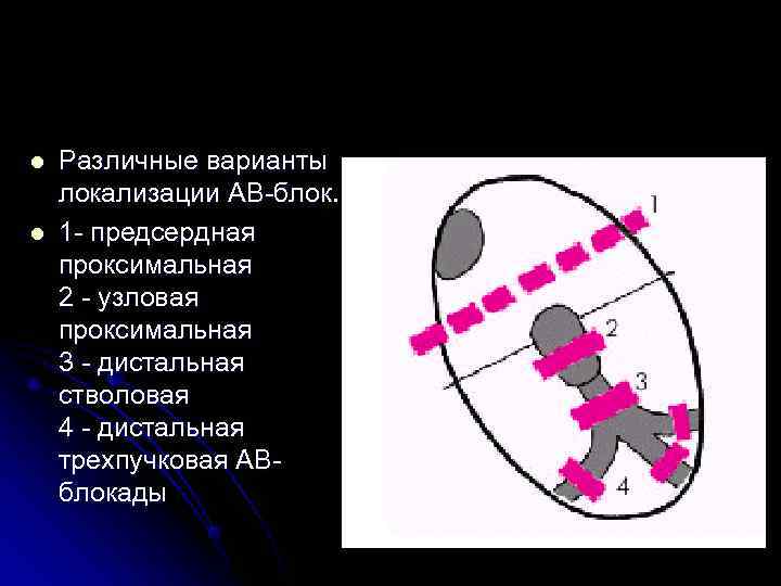 l Различные варианты локализации АВ-блок. l 1 - предсердная проксимальная 2 - l Различные варианты локализации АВ-блок. l 1 - предсердная проксимальная 2 -