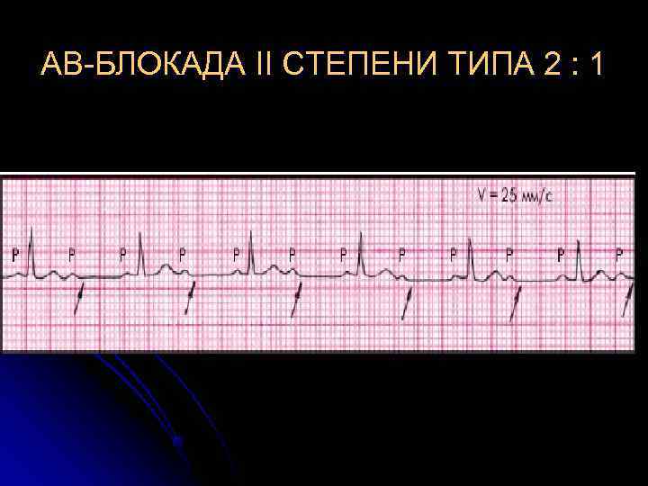 Ав блокада 2 степени