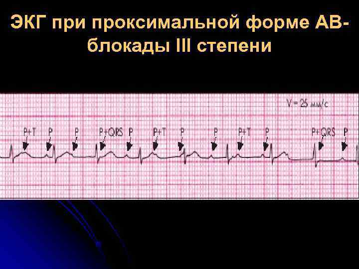 ЭКГ при проксимальной форме АВ- блокады III степени ЭКГ при проксимальной форме АВ- блокады III степени