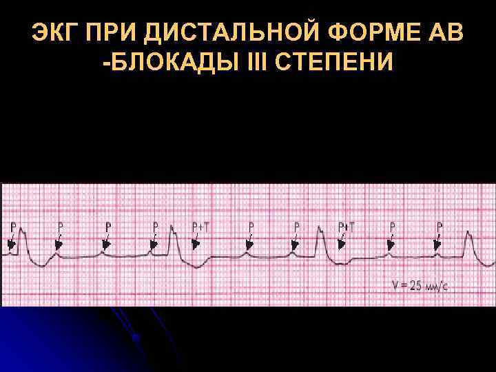 ЭКГ ПРИ ДИСТАЛЬНОЙ ФОРМЕ АВ -БЛОКАДЫ III СТЕПЕНИ ЭКГ ПРИ ДИСТАЛЬНОЙ ФОРМЕ АВ -БЛОКАДЫ III СТЕПЕНИ