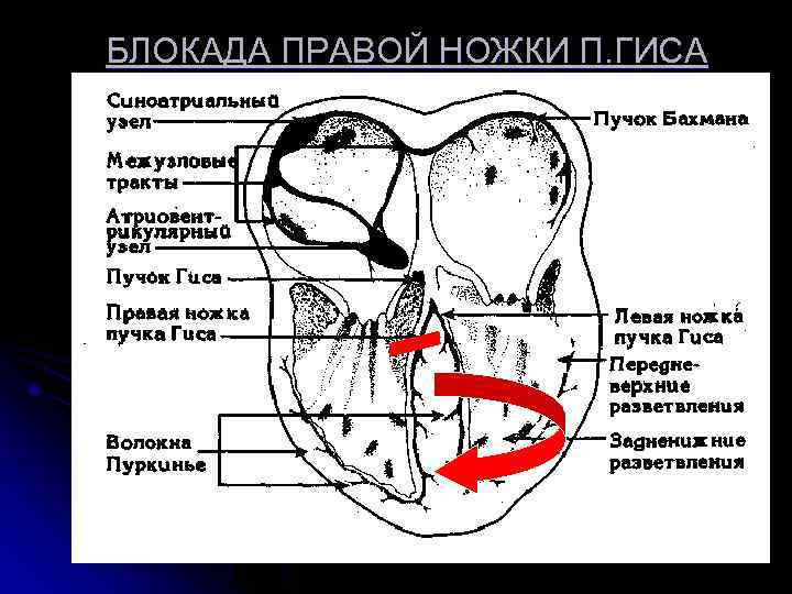 БЛОКАДА ПРАВОЙ НОЖКИ П. ГИСА БЛОКАДА ПРАВОЙ НОЖКИ П. ГИСА
