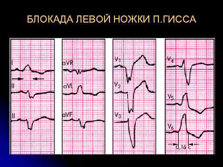 БЛОКАДА ЛЕВОЙ НОЖКИ П. ГИССА БЛОКАДА ЛЕВОЙ НОЖКИ П. ГИССА