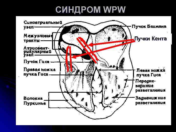 СИНДРОМ WPW Пучки Кента СИНДРОМ WPW Пучки Кента