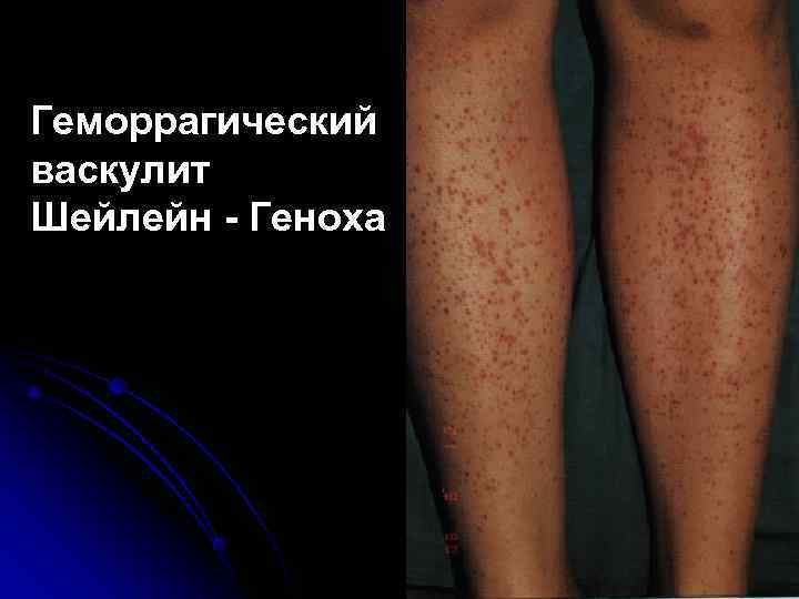 Геморрагический васкулит Шейлейн - Геноха 