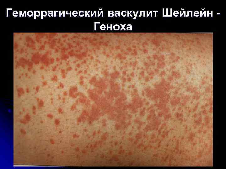 Геморрагический васкулит Шейлейн -    Геноха 