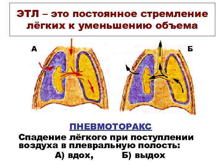 ЭТЛ – это постоянное стремление лёгких к уменьшению объема  А   