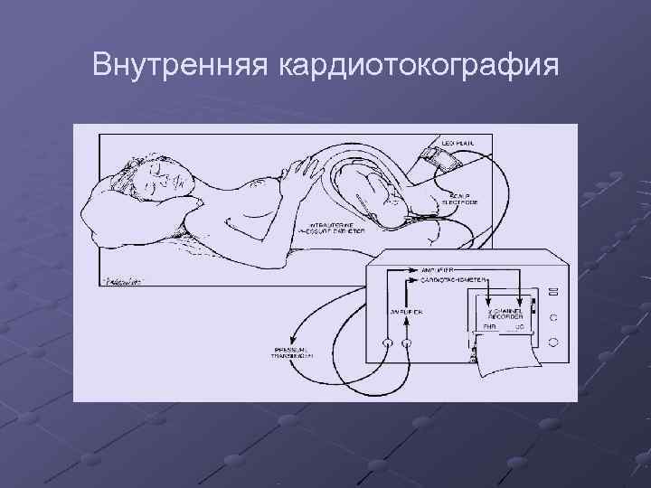 Внутренняя кардиотокография 