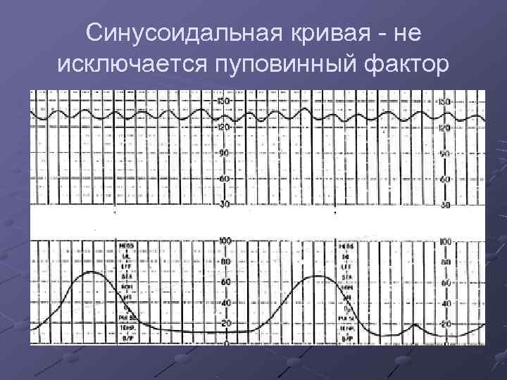  Синусоидальная кривая - не исключается пуповинный фактор 