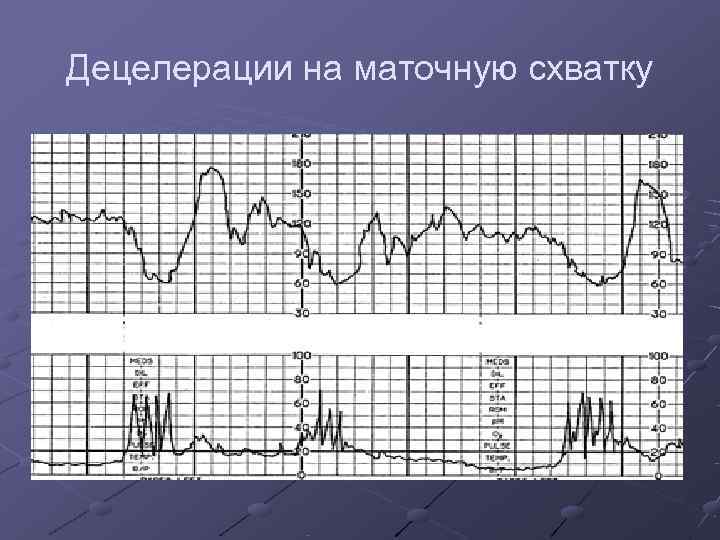 Децелерации на маточную схватку 