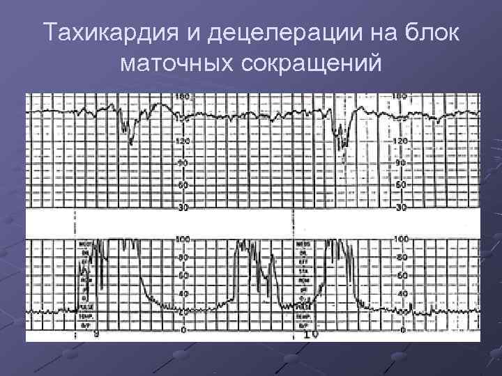 Тахикардия и децелерации на блок  маточных сокращений 