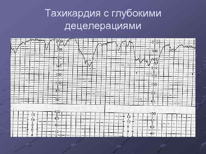 Тахикардия с глубокими децелерациями 