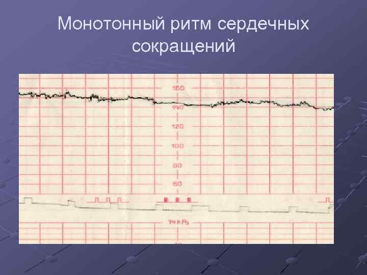 Монотонный ритм сердечных  сокращений 