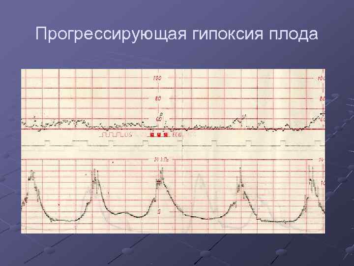 Прогрессирующая гипоксия плода 