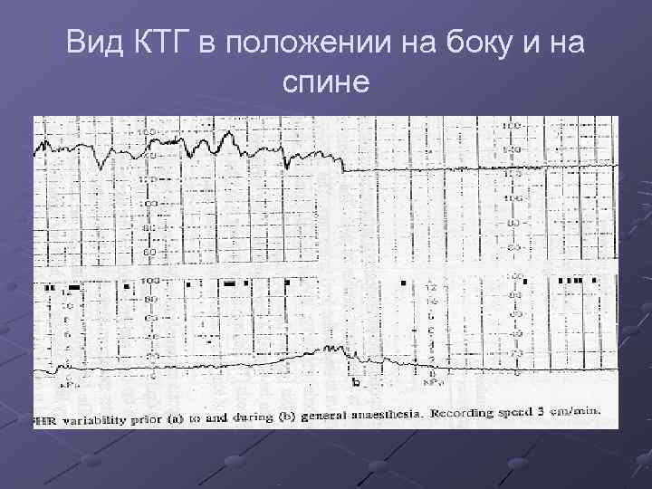 Вид КТГ в положении на боку и на   спине 