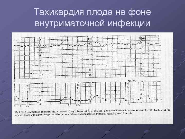 Тахикардия плода на фоне внутриматочной инфекции 