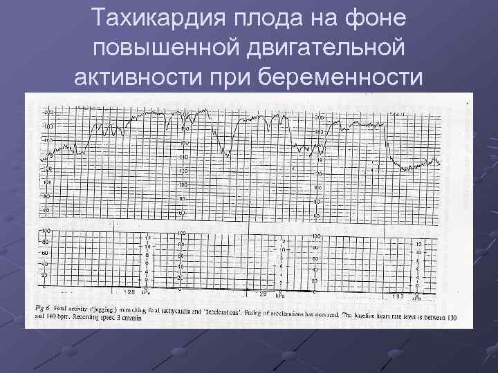  Тахикардия плода на фоне повышенной двигательной активности при беременности 