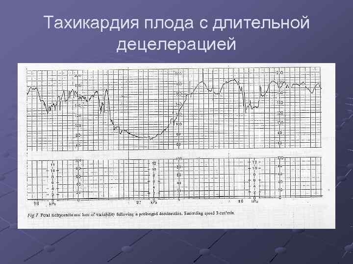 Тахикардия плода с длительной   децелерацией 