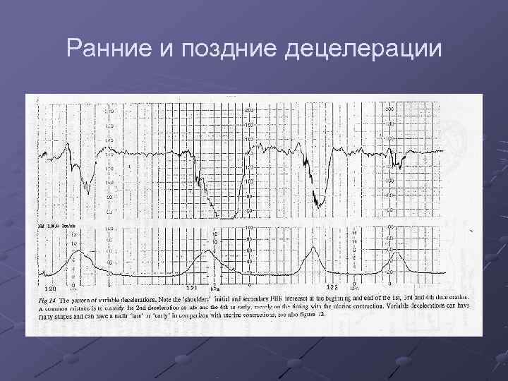 Ранние и поздние децелерации 