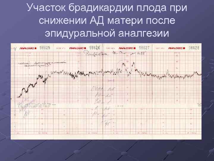 Участок брадикардии плода при  снижении АД матери после  эпидуральной аналгезии 