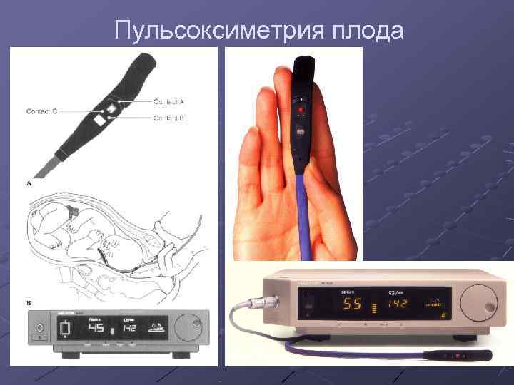 Пульсоксиметрия плода 