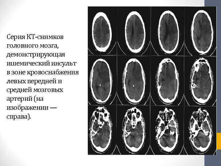 Ишемический инсульт фото мозга