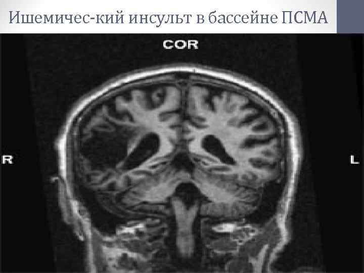 Ишемичес-кий инсульт в бассейне ПСМА 