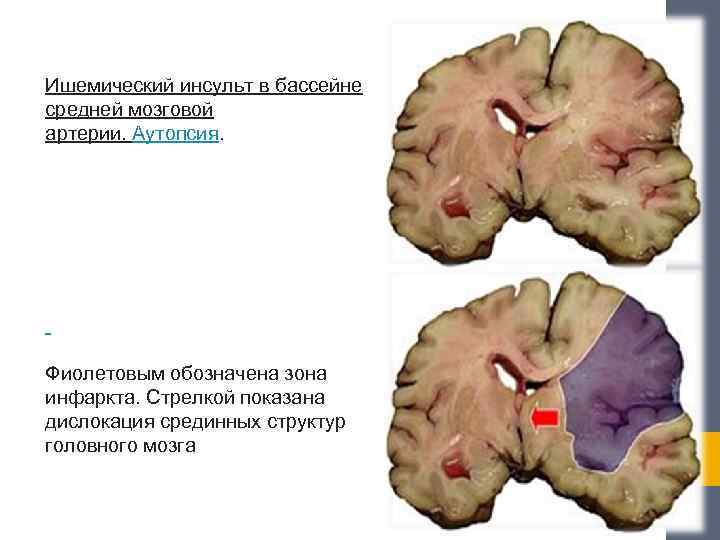 Ишемический инсульт в бассейне средней мозговой артерии. Аутопсия. Фиолетовым обозначена зона инфаркта. Стрелкой показана