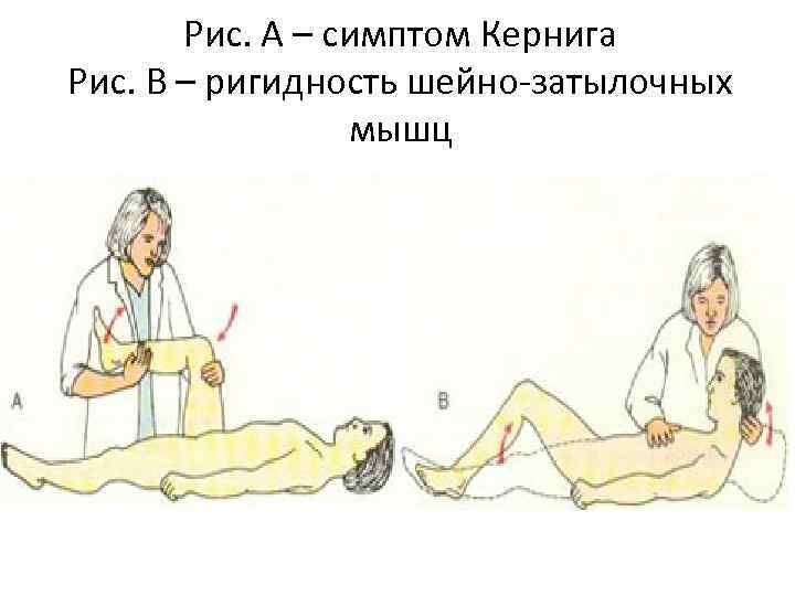   Рис. А – симптом Кернига Рис. В – ригидность шейно-затылочных  