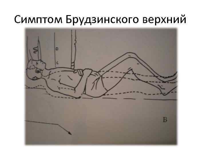 Симптом Брудзинского верхний 