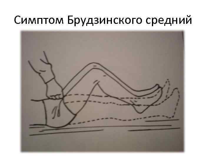 Симптом Брудзинского средний 