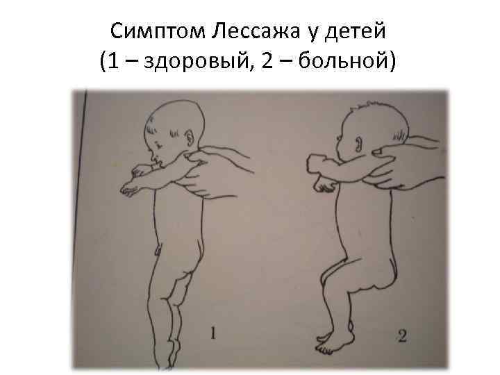  Симптом Лессажа у детей (1 – здоровый, 2 – больной) 