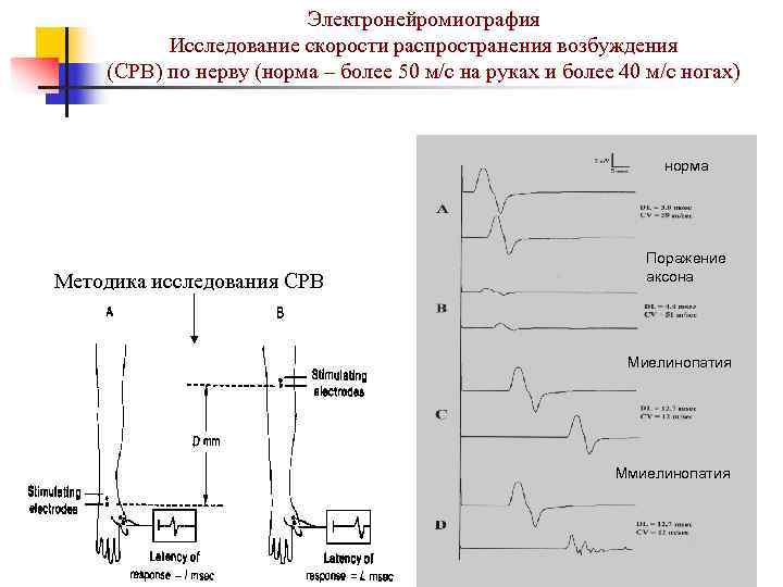     Электронейромиография  Исследование скорости распространения возбуждения (СРВ) по нерву (норма