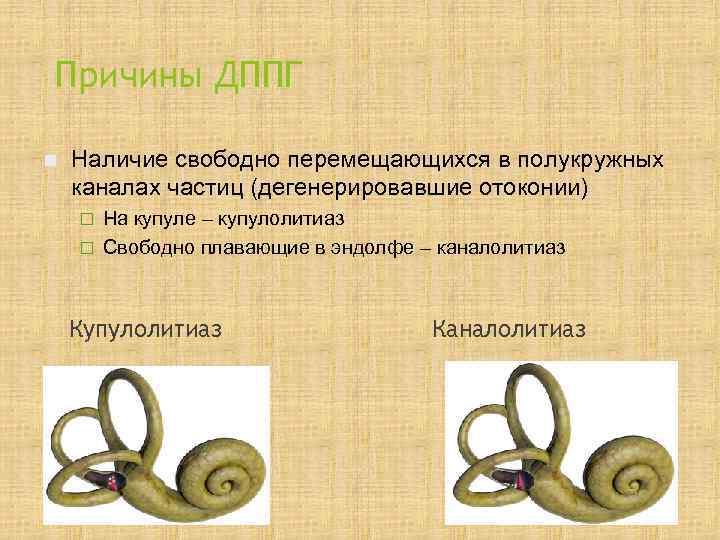 Причины ДППГ n  Наличие свободно перемещающихся в полукружных каналах частиц (дегенерировавшие отоконии) ¨