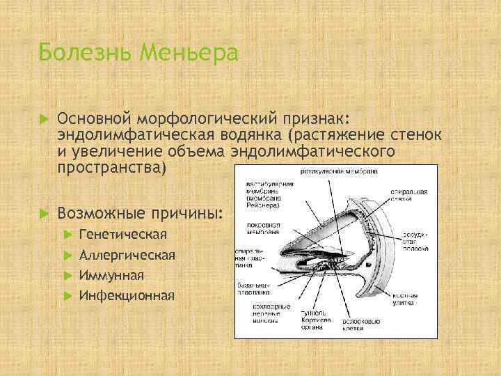 Болезнь Меньера Основной морфологический признак: эндолимфатическая водянка (растяжение стенок и увеличение объема эндолимфатического пространства)