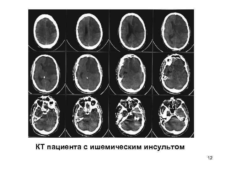 КТ пациента с ишемическим инсультом 12 КТ пациента с ишемическим инсультом 12