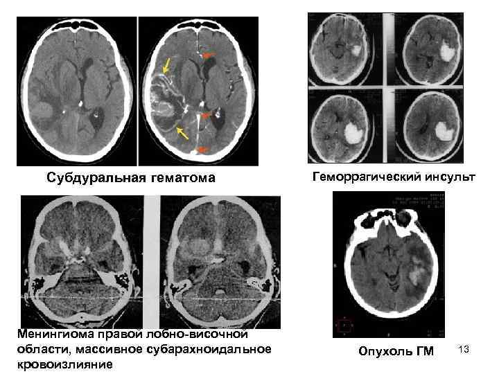 Субдуральная гематома Геморрагический инсульт Менингиома правой лобно-височной области, массивное Субдуральная гематома Геморрагический инсульт Менингиома правой лобно-височной области, массивное
