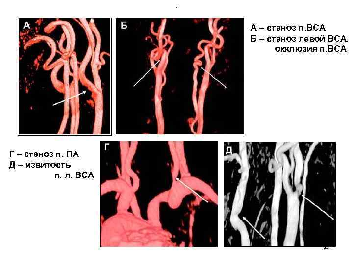А – стеноз п. ВСА А – стеноз п. ВСА
