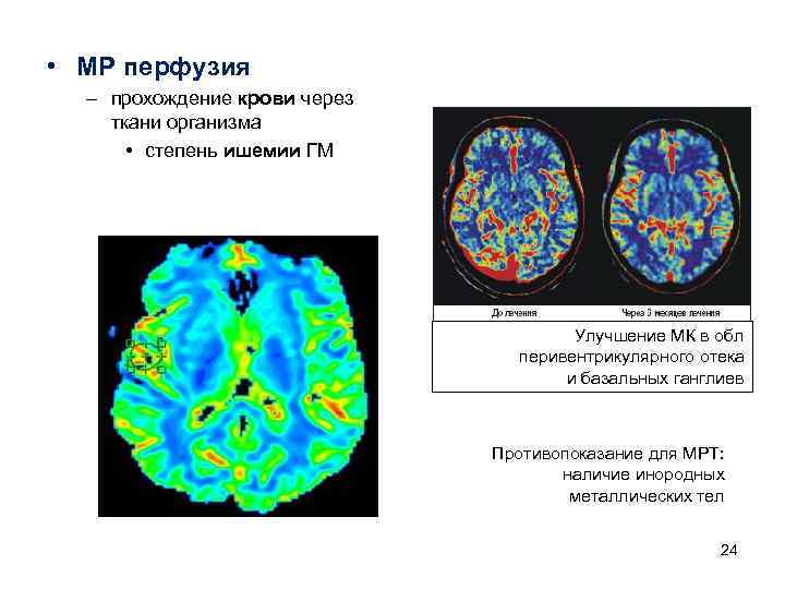 • МР перфузия – прохождение крови через ткани организма • степень • МР перфузия – прохождение крови через ткани организма • степень