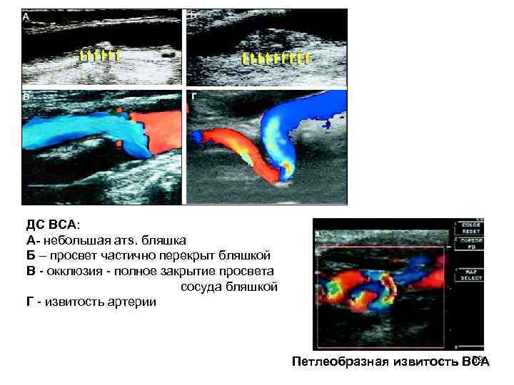 ДС ВСА: А- небольшая атs. бляшка Б – просвет частично перекрыт бляшкой В ДС ВСА: А- небольшая атs. бляшка Б – просвет частично перекрыт бляшкой В