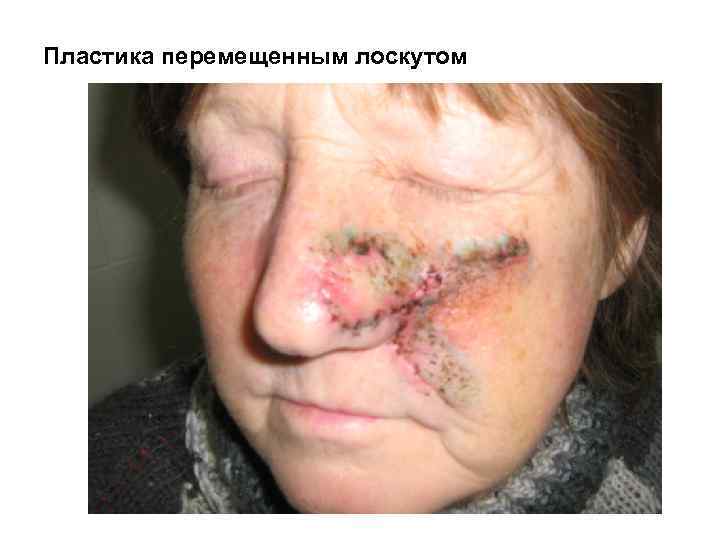 Пластика перемещенным лоскутом 