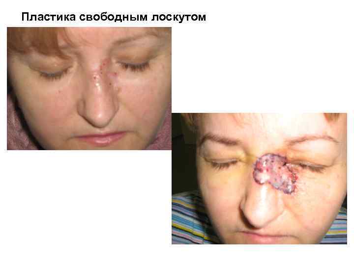 Пластика свободным лоскутом 