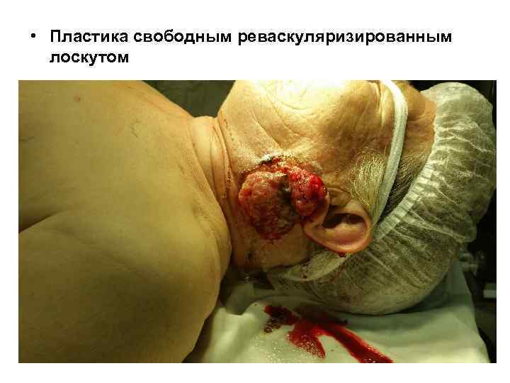  • Пластика свободным реваскуляризированным  лоскутом 