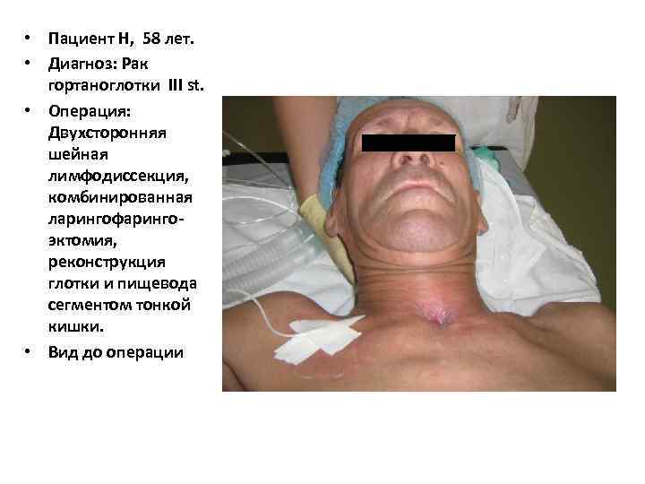  • Пациент Н, 58 лет.  • Диагноз: Рак  гортаноглотки III st.