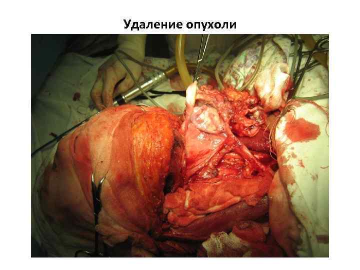 Удаление опухоли 