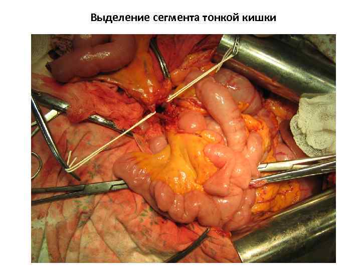Выделение сегмента тонкой кишки 