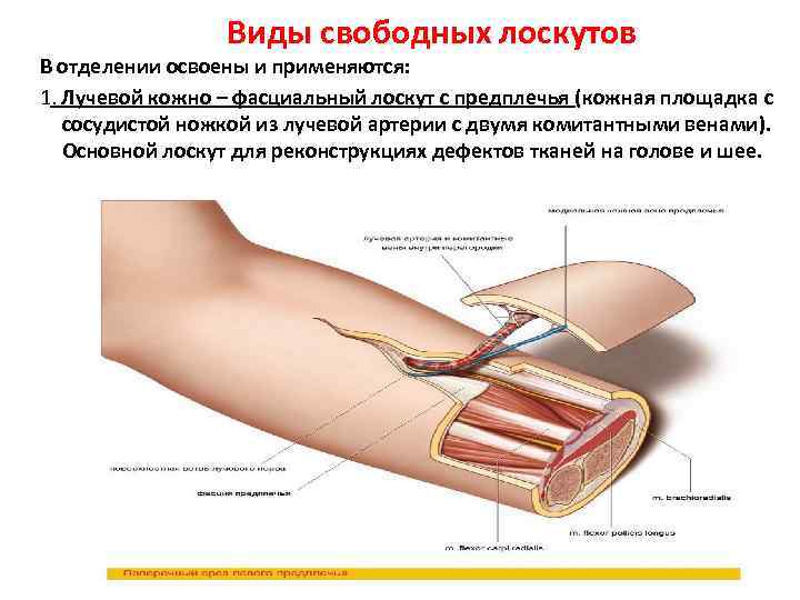    Виды свободных лоскутов В отделении освоены и применяются: 1. Лучевой кожно