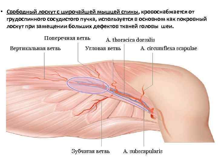  • Свободный лоскут с широчайшей мышцей спины, кровоснабжается от  грудоспинного сосудистого пучка,