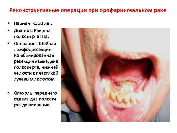 Реконструктивные операции при орофарингеальном раке  • Пациент С, 50 лет.  • Диагноз: