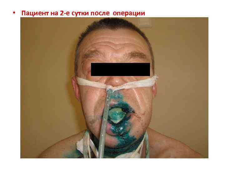  • Пациент на 2 -е сутки после операции 