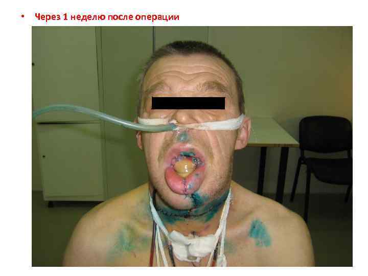  • Через 1 неделю после операции 